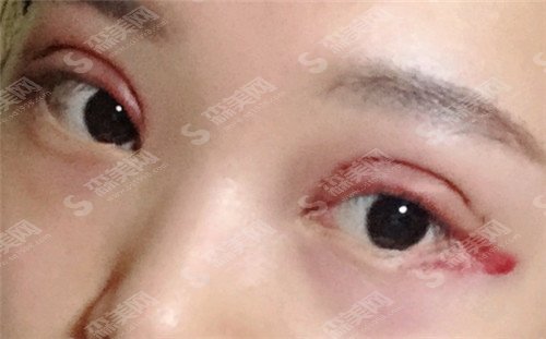 上海九院修复双眼皮哪个医生比较好?张路,刘菲,朱海男值得推荐!