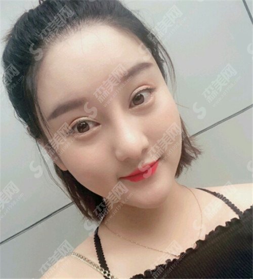 郑州第二附属医院杨丽双眼皮怎么样?郑州第二附属医院概括及案例介绍