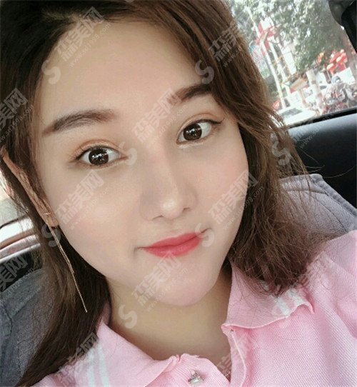 郑州第二附属医院杨丽双眼皮怎么样?郑州第二附属医院概括及案例介绍