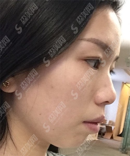 郑州美丽时光整形医院杨瑞国好吗?医院什么情况?亲身案例有没有?