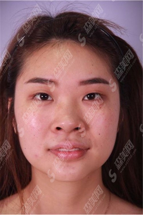 哈医大二院整形外科刘国锋整形医生手出芙蓉技术了得,看了案例就会深有体会