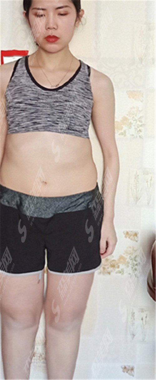 北大深圳医院胡华新值得选择吗?北大深圳医院怎么样?有没有较新案例和价格表?