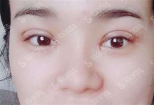 华东医院刘天一医生割双眼皮怎么样? 华东医院什么情况?做双眼皮需要多少钱?