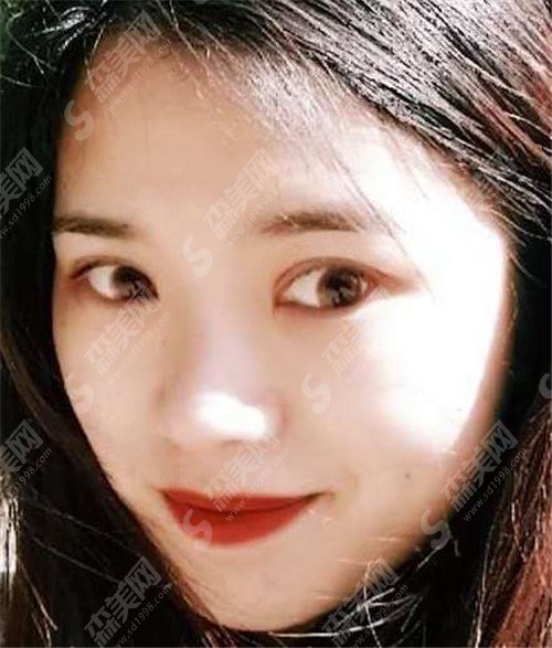 华东医院刘天一医生割双眼皮怎么样? 华东医院什么情况?做双眼皮需要多少钱?