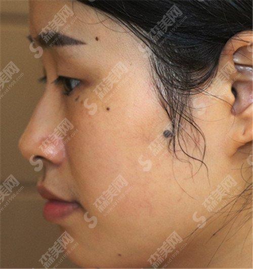 上海九院做双眼皮厉害的医生有哪些?苏薇洁,顾斌,朱海南都是业内高手