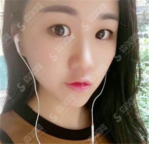 上海九院陈辉医生简介和九院的实际情况+双眼皮案例(附价格明细表)