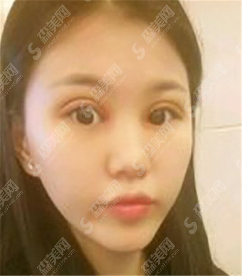 上海九院陈辉医生简介和九院的实际情况+双眼皮案例(附价格明细表)