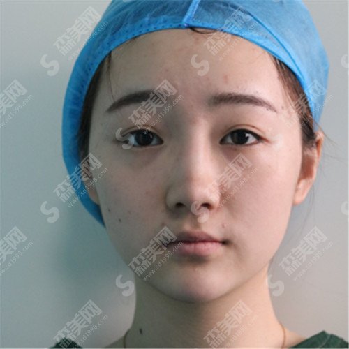 白永辉和王振军谁的双眼皮修复技术好？这位医院信息大盘点+真实案例