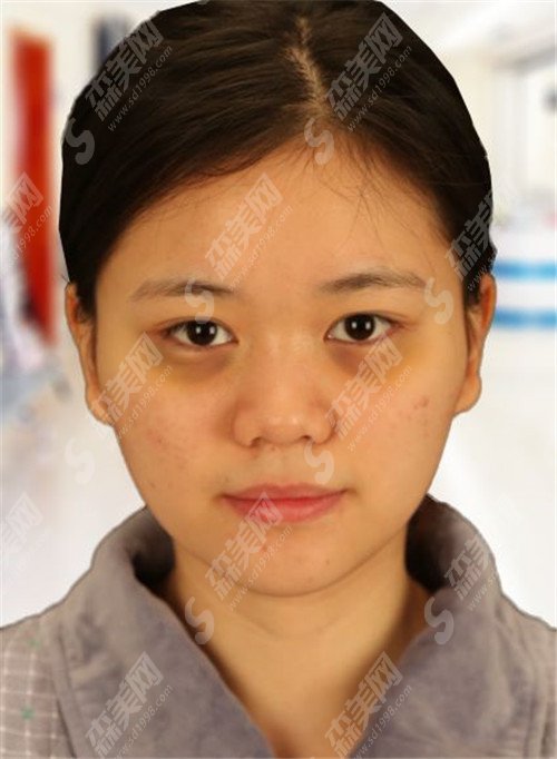 格莱丽整形美容医院怎么样? 医生整形技术怎样呢?医生真实整形案例分享