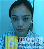 北京鼻头鼻翼缩小案例