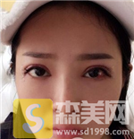 上海九院朱海男双眼皮果好不好？内含双眼皮案例果+前后果对比