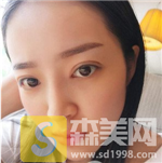 上海九院朱海男双眼皮果好不好？内含双眼皮案例果+前后果对比