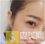 上海九院朱海男双眼皮果好不好？内含双眼皮案例果+前后果对比