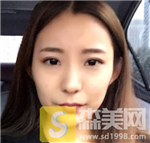 北京玻尿酸填充全脸术后案例分享