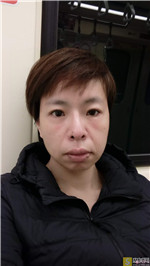 UC首尔牙科突嘴矫正案例怎么样?附相关矫正案例展示