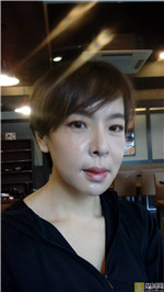 UC首尔牙科突嘴矫正案例怎么样?附相关矫正案例展示