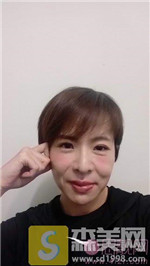 UC首尔牙科突嘴矫正案例怎么样?附相关矫正案例展示