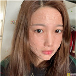 成都伊生美自体脂肪全脸填充怎么样?填充项目价目表+相关案例展示