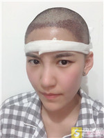 成都恒博植发兰京种植发际线怎么样？相关案例展示+2021项目价目表