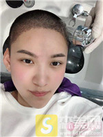 成都恒博植发兰京种植发际线怎么样？相关案例展示+2021项目价目表