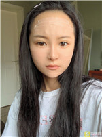 成都赵善军博士自体脂肪全脸填充好不好?填充案例前后对比+2021项目价目表