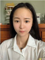 成都赵善军博士自体脂肪全脸填充好不好?填充案例前后对比+2021项目价目表