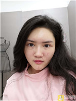 福州星龄黎护忠自体脂肪全脸填充怎么样?自体脂肪填充案例展示+2021项目价目表