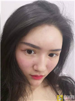 福州星龄黎护忠自体脂肪全脸填充怎么样?自体脂肪填充案例展示+2021项目价目表