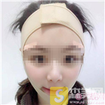 厦门美丽薇医疗美容诊所面部吸脂怎么样？吸脂案例展示+2021项目价目表