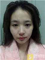 南京美范陈雪峰自体脂肪全脸填充怎么样?自体填充相关案例+2021项目价目表