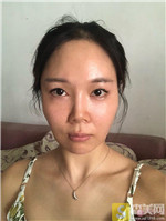 天津和平高丽美迹张亚丽医生如何？自体脂肪填充案例+2021填充价目表