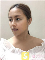 北京京韩乔爱军自体脂肪全脸填充怎么样?韩乔爱相关案例展示+2021项目价目表