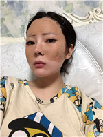 济南美辰医疗美容医院怎么样？自体脂肪填充全脸案例果+2021填充价格表