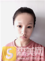 成都碧莲盛植发种植发际线好不好？植发相关案例展示+2021植发价目表