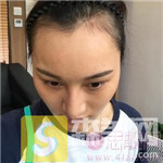 成都恒博植发医院种植发际线怎么样？附种植真人案例分享及2020价格表一览