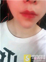 成都美熹刘家亘硅胶垫下巴怎么样?真人案例展示+2021价目表曝光