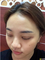 成都纽莱茵自体脂肪全脸填充如何?填充案例分享+2021项目价目表