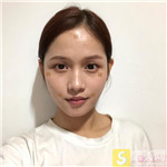 厦门思明云艺美自体脂肪填充全脸好吗？附2021填充价格表+真人分享案例