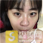 上海首尔丽格金柱自体脂肪全脸填充好吗?填充案例+2021价目表