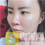 上海首尔丽格金柱自体脂肪全脸填充好吗?填充案例+2021价目表