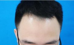 这次的头顶植发经历，真的让人大叫哇塞，实在是太好了