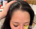 上海薇琳陈凡凡种植发际线如何？种植发际线真人案例展示+2021项目价目表