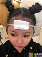 上海薇琳陈凡凡种植发际线如何？种植发际线真人案例展示+2021项目价目表