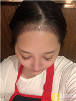 上海薇琳陈凡凡种植发际线如何？种植发际线真人案例展示+2021项目价目表