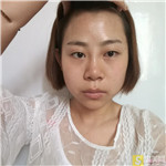 成都恩美自体脂肪全脸填充怎么样?全脸填充真人案例分享