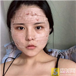 成都美容整形医院李静医生自体脂肪全脸填充好吗?填充案例分享