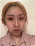 深圳南西子郑举卫自体脂肪全脸填充怎么样？附2021填充价目表