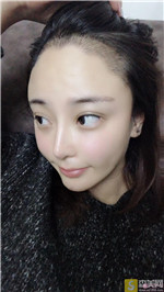 [大麦微针植发]北京总院殷灿昌种植发际线怎么样？附真人案例展示