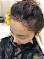 [大麦微针植发]北京总院殷灿昌种植发际线怎么样？附真人案例展示