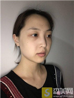 太原显微植发王亚丽医生种植发际线好不好?相关案例_2021相关价目表